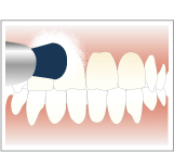 歯のクリーニング